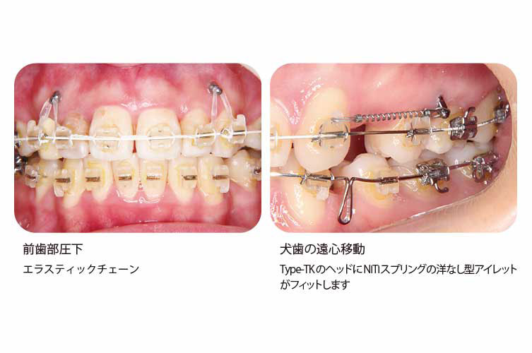 B-max ｽｸﾘｭｰ Type-TK # φ1.4×6mm